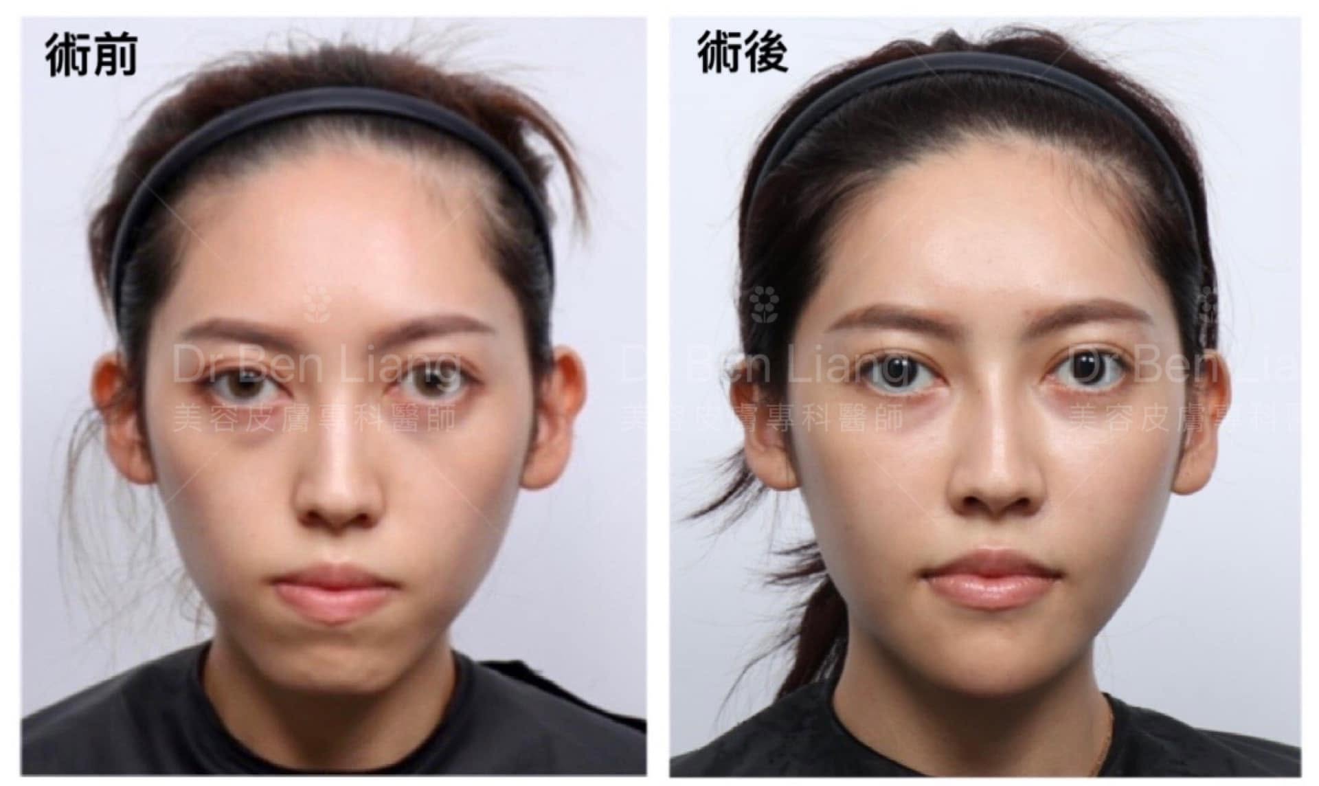藝術面雕 Plus Part 2 內輪廓與外輪廓術前後比較